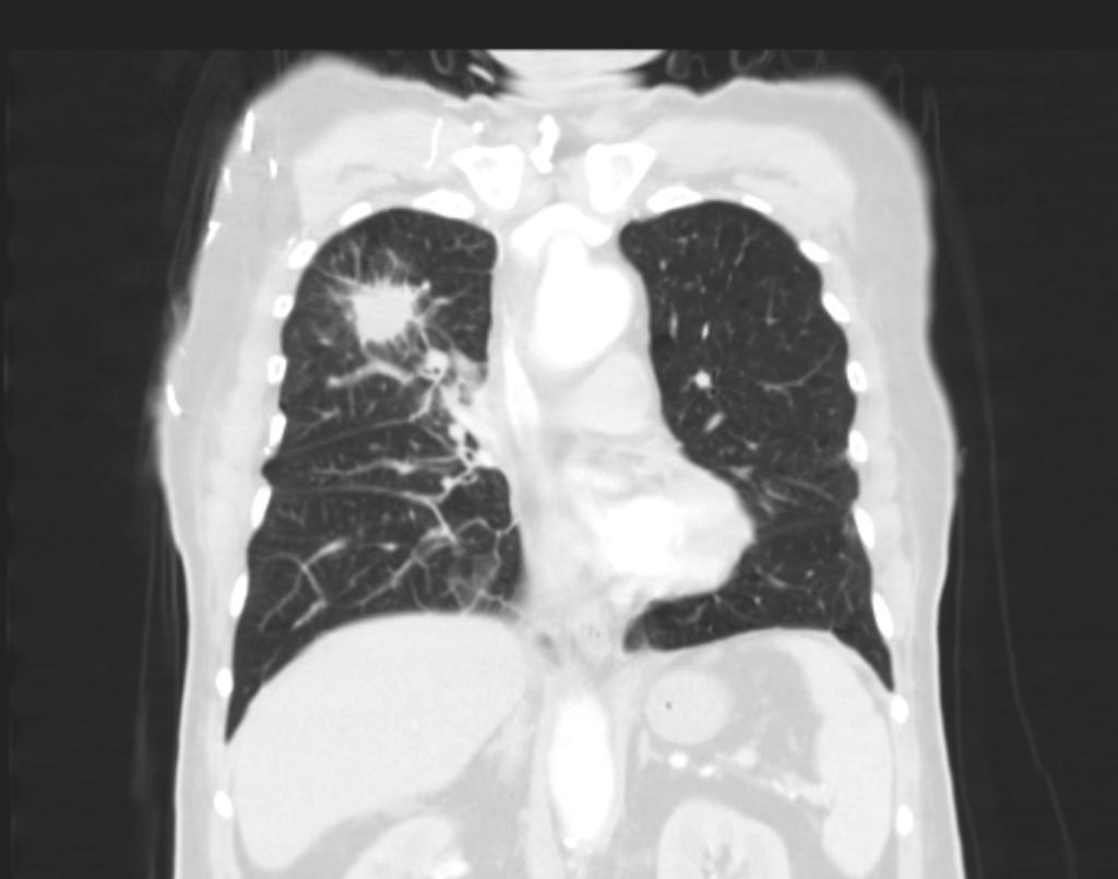Bronchogenic lung carcincoma: upper lobe with lymphangitic spread
