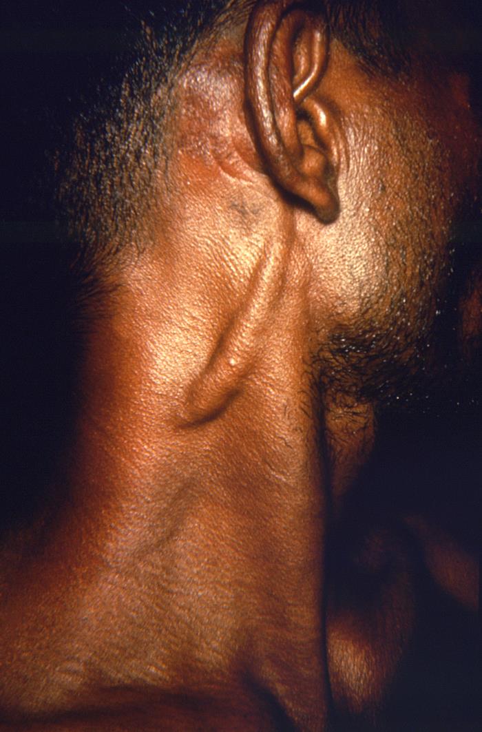 Enlargement of the great auricular nerve following attack by Mycobacterium leprae.Adapted from Public Health Image Library (PHIL), Centers for Disease Control and PreventionPublic Health Image Library (PHIL), Centers for Disease Control and Prevention[5]