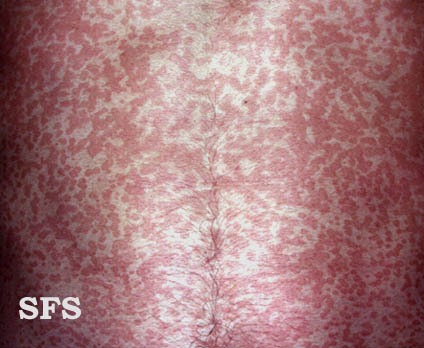 Pityriasis versicolor. Adapted from Dermatology Atlas.[1]