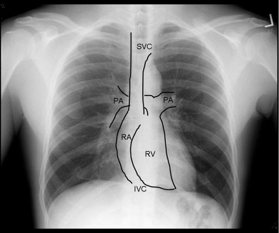 The chest x-ray in cardiovascular disease - wikidoc