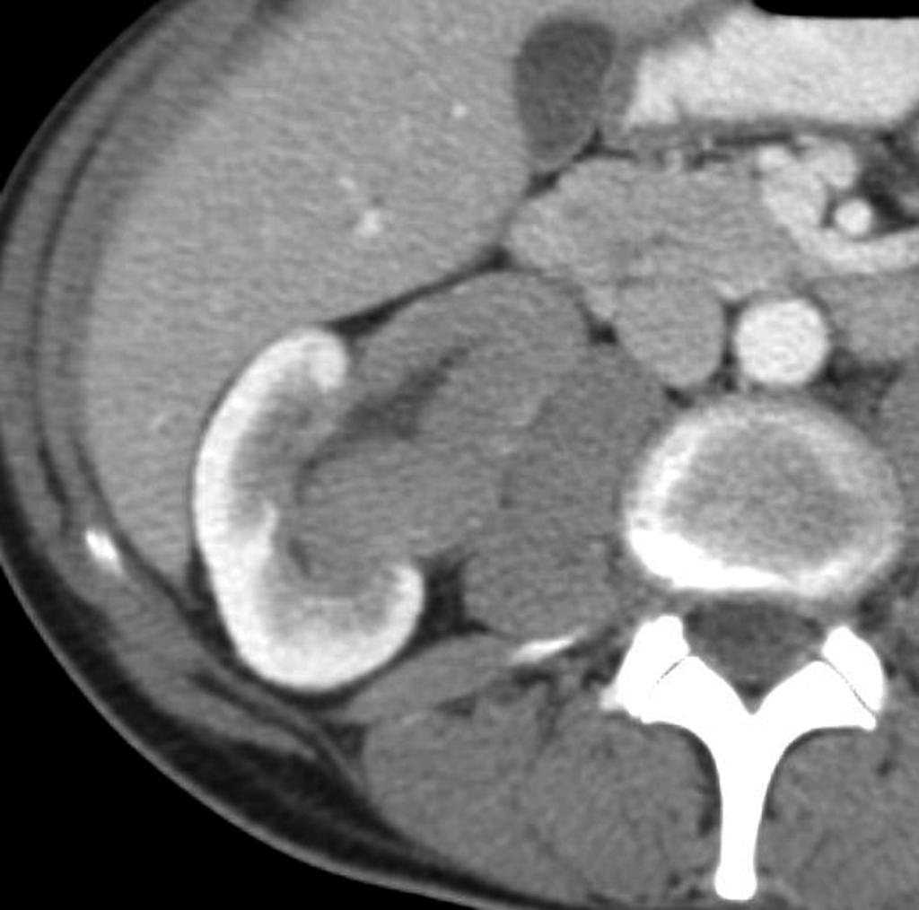 File:Transitional-cell-carcinoma-of-the-renal-pelvis.jpg