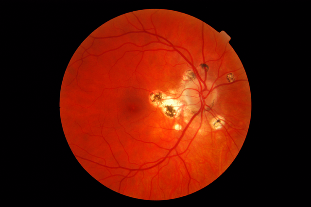 Retinal photograph of ocular histoplasmosis