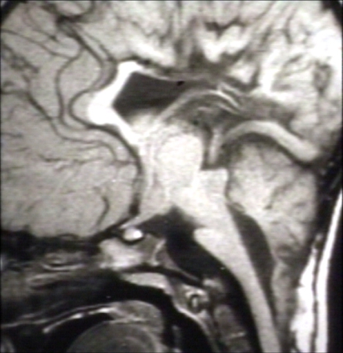 BRAIN: ARNOLD CHIARI II WITH ELONGATED FOURTH VENTRICLES AND STENOGYRIA; T1 (MRI)