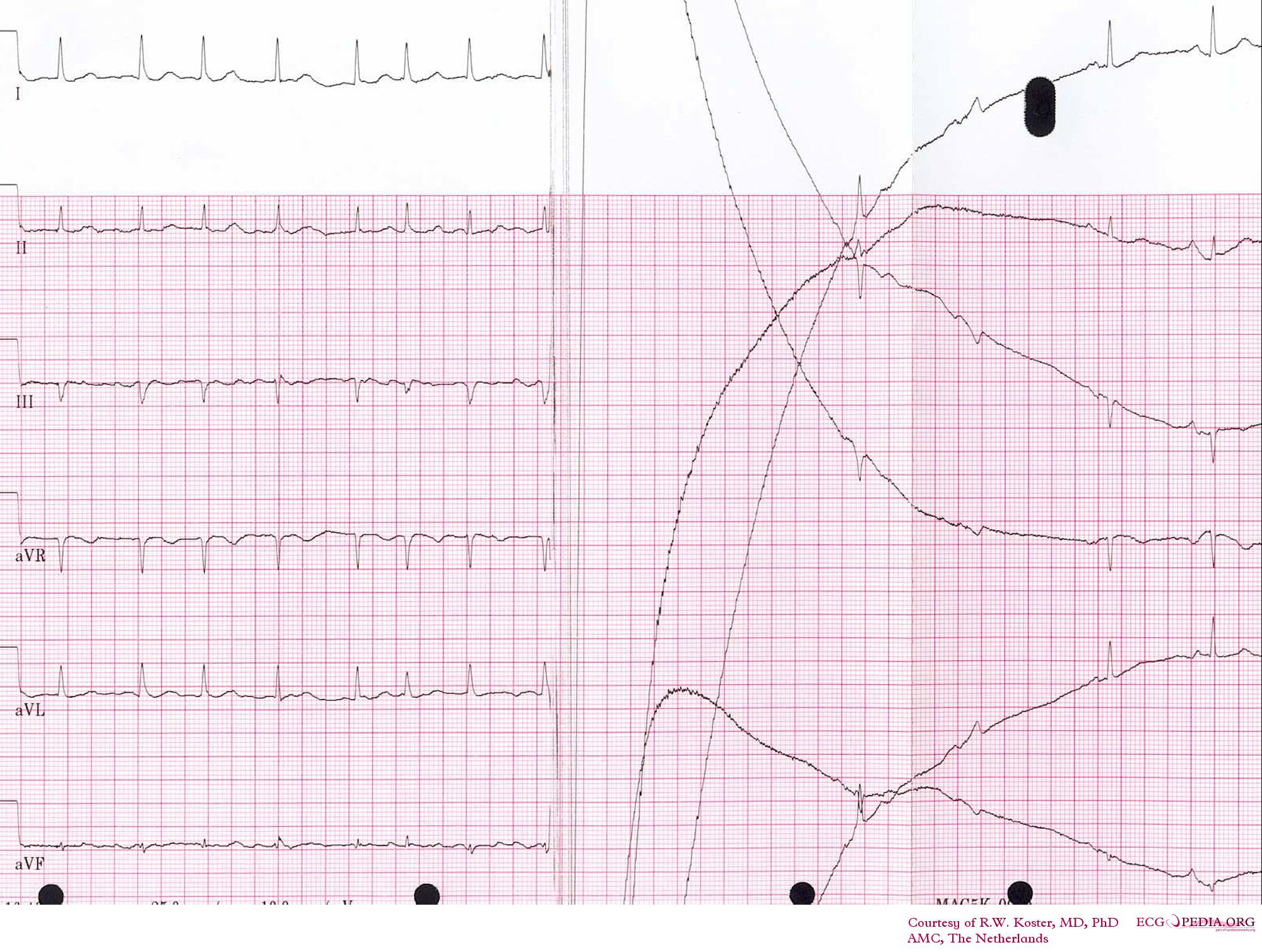 Cardioversion from atrial fibrillation to sinus rhythm, with clear baseline drift.