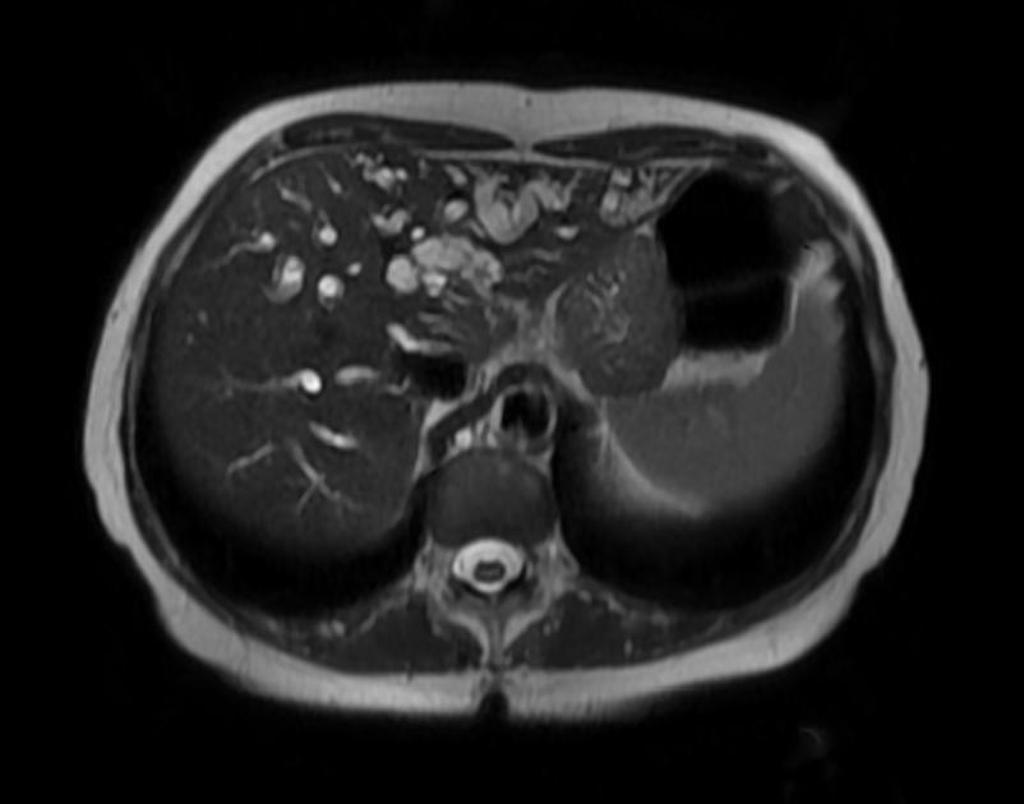 File:Gallbladder-adenocarcinoma.jpg