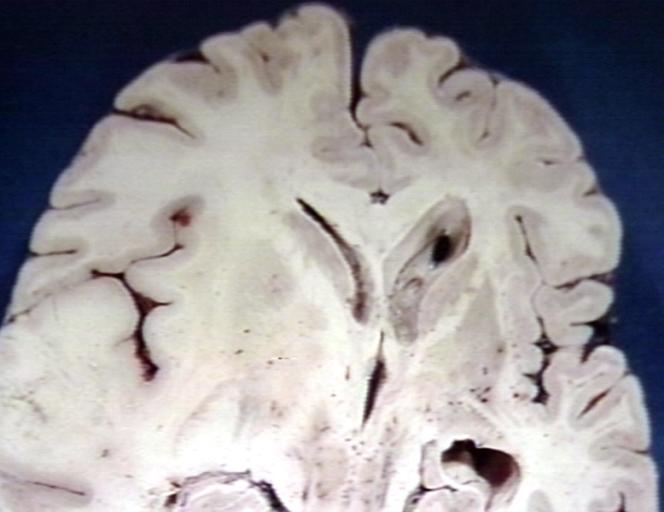 Brain: Glioma, Grade II Anaplastic