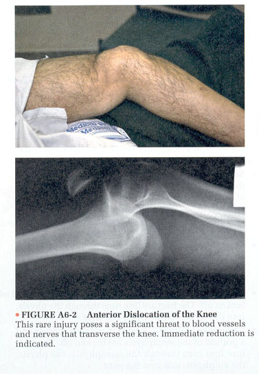 File:Knee dislocation 3.jpg