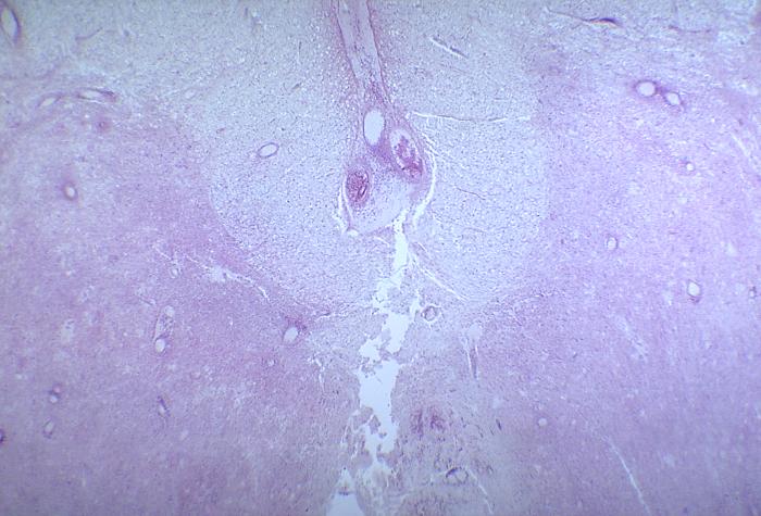 A photomicrograph of the lumbar spinal cord depicting degenerative changes due to an infarct caused by Polio Type III.Adapted from Public Health Image Library (PHIL), Centers for Disease Control and Prevention.[13]