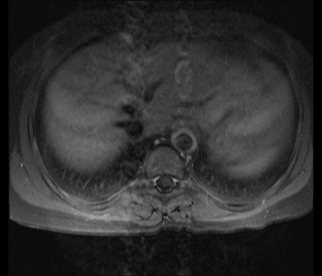 MRA: A 15 year-old girl with known Takayasu arteritis presented for MRI to investigate back pain. The axial T1-weighted post-gadolinium MRI above shows thickened, enhancing aortic wall, consistent with large vessel vasculitis. (Image courtesy of Dr Laughlin Dawes)