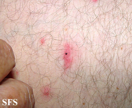 Tick bite. Adapted from Dermatology Atlas.[1]