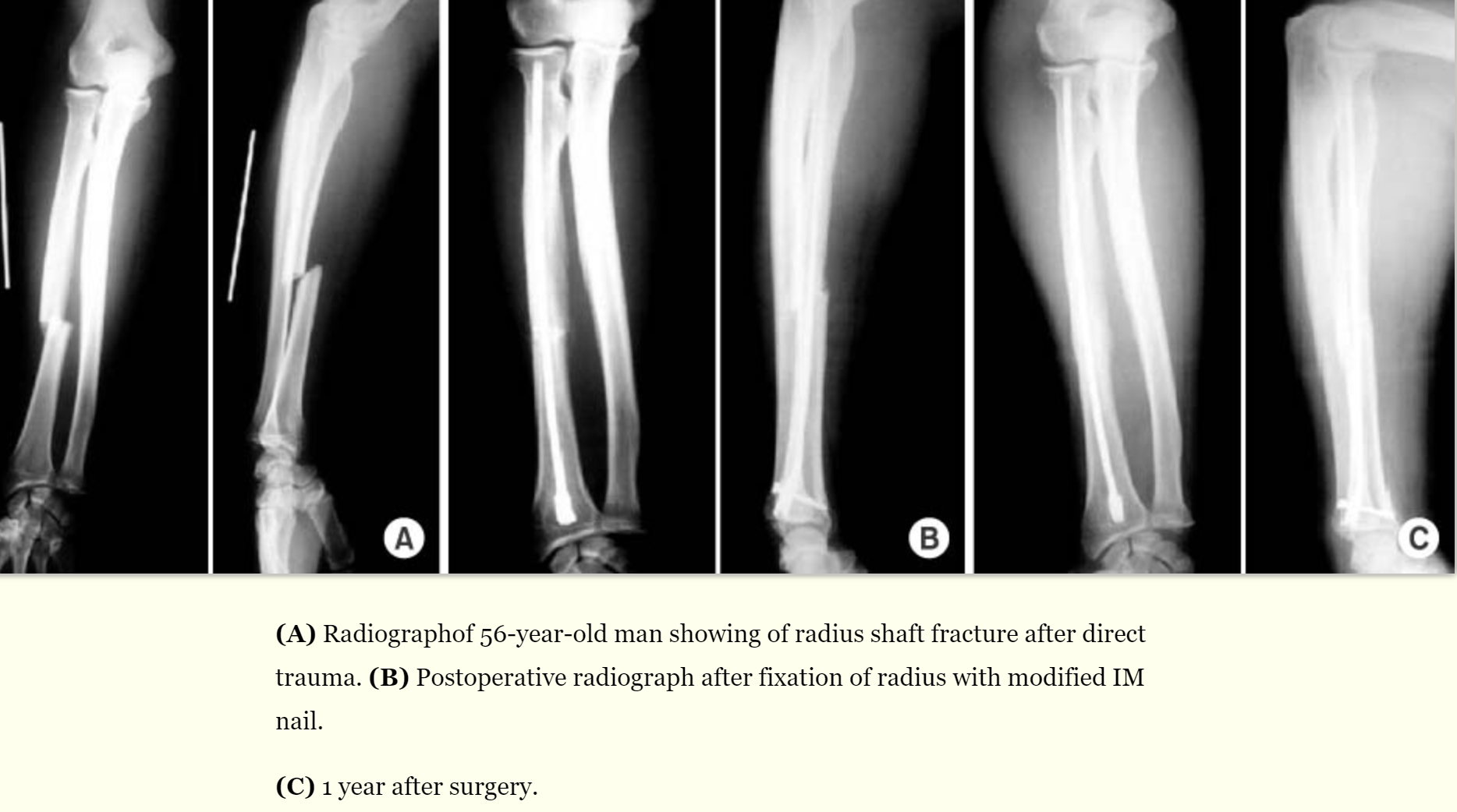 File:Ulna fracture intramedullary nailing.png