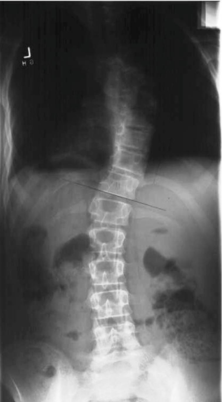 File:Xray Scoliosis Turner Syndrome.JPG