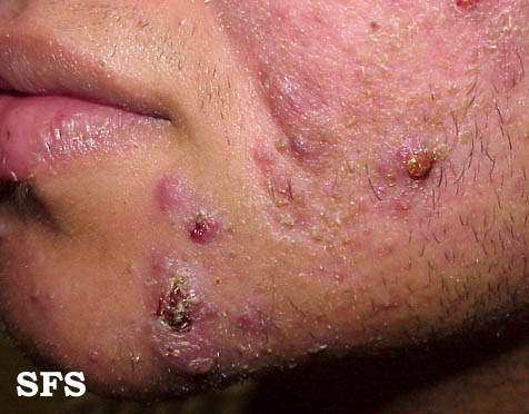 Acne vulgaris. Adapted from Dermatology Atlas[1]