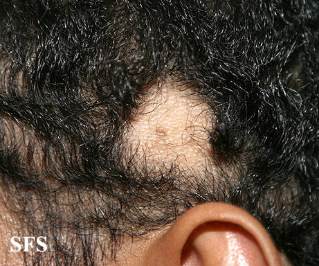 File:Alopecia acquisitum centrifugum07.jpg