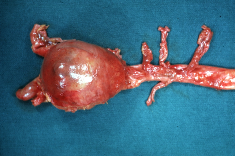 Abdominal Aneurysm: Gross, natural color, unopened large and quite typical aneurysm extending from below renal arteries to bifurcation