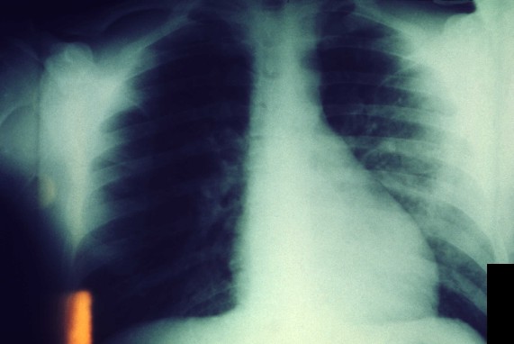 Bilateral Pulmonary Infection Greater in Left Lung