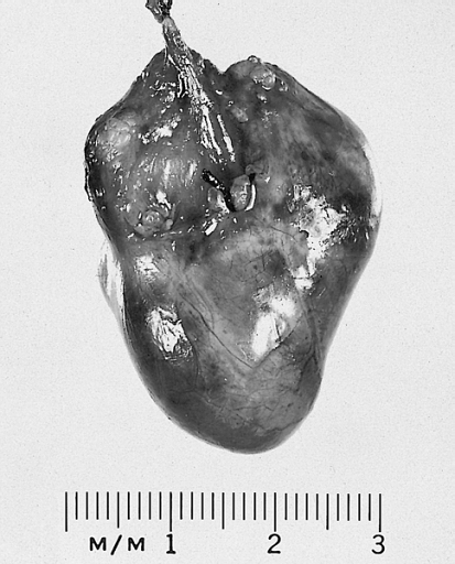 Bronchogenic cyst: This example was removed from the epicardial surface of a 13-year-old.