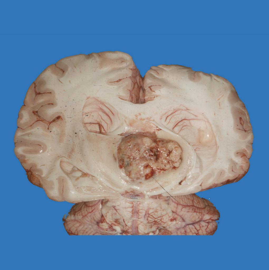 An autopsy specimen showing a rather large pineal tumor. It was a pineoblastoma composed of highly cellular sheets of anaplastic cells with irregular hyperchromatic nuclei and brisk mitotic activity – resembling medulloblastoma and retinoblastoma.[6]