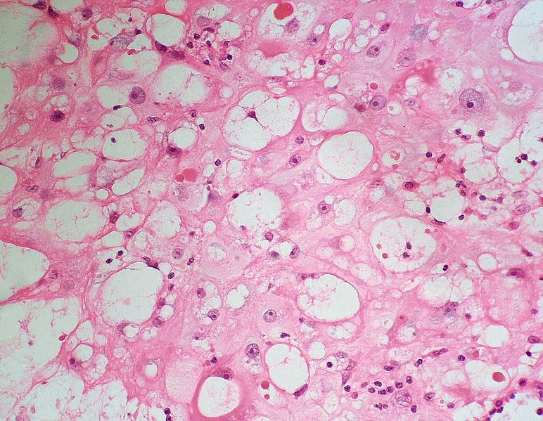 Physaliphorous cells.[6]