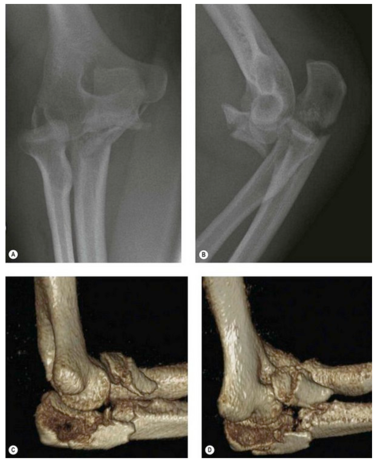 File:Type II Monteggia fracture dislocation. (A, B) The radiographs do not show the exact anatomy of the proximal ulna fracture. (C, D) CT 3-D reconstruction of the same patient clearly identifies the fracture morphology..png