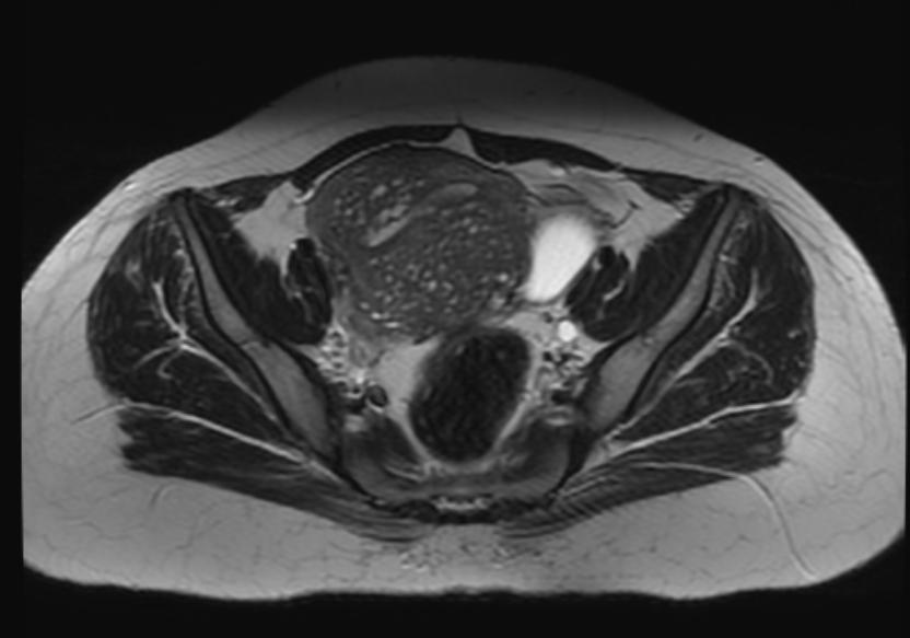 File:Adenomyosis MRI 104.jpg