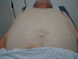 Separation of rectus abdominus muscles which occasionally occurs in older patients and or those with weakening of the abdominal musculature.