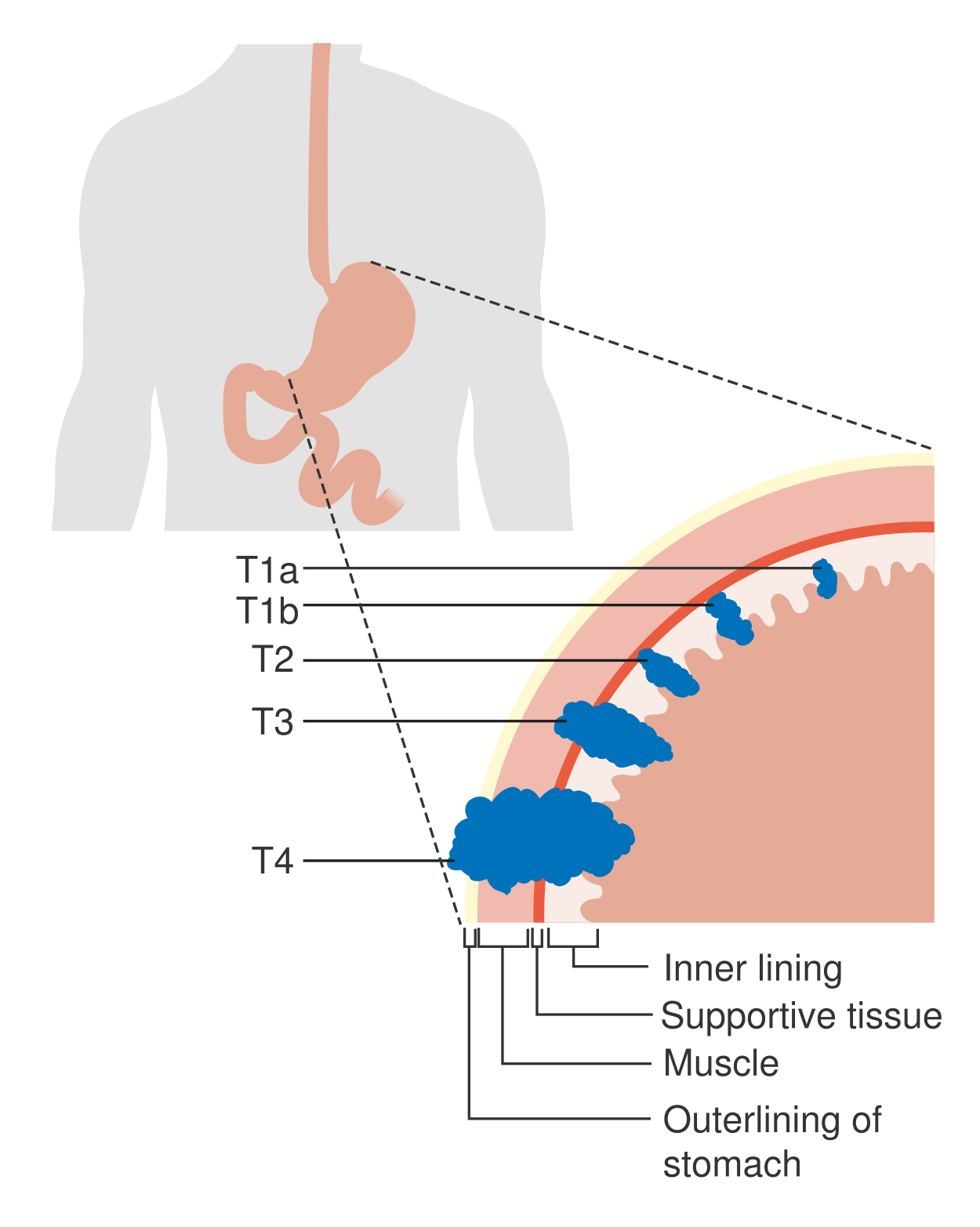 File:Diagram showing the T stages of stomach cancer CRUK 374.png