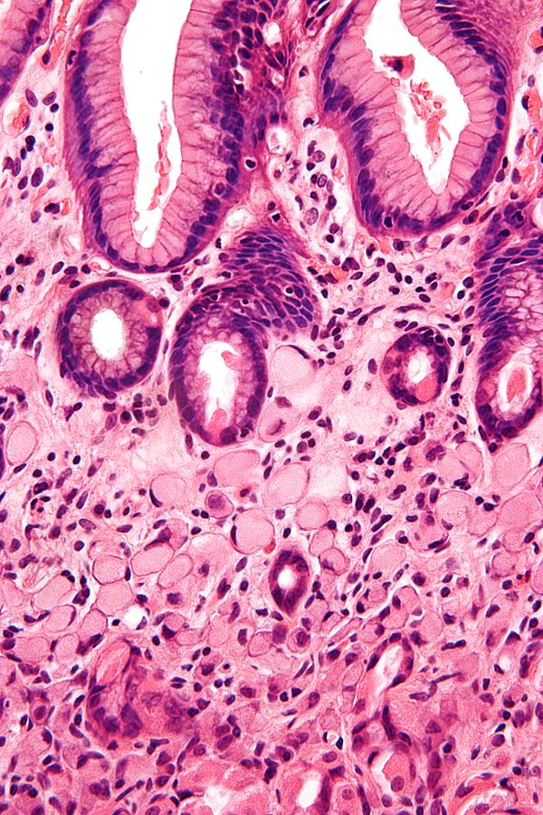 A signet ring cell carcinoma of the stomach. Signet ring cells are seen in the lower half of the image. Gastric epithelium is seen in the upper half of the image. H&E stain.[9]
