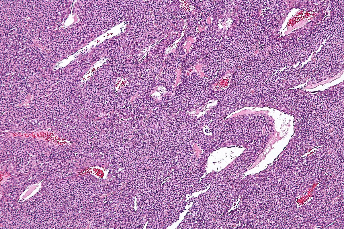Intermediate magnification micrograph of a glomus tumor. H&E stain.[10]