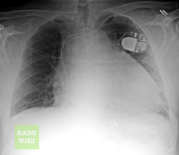 Chest x-ray: Pericardial effusion. The second day of admission