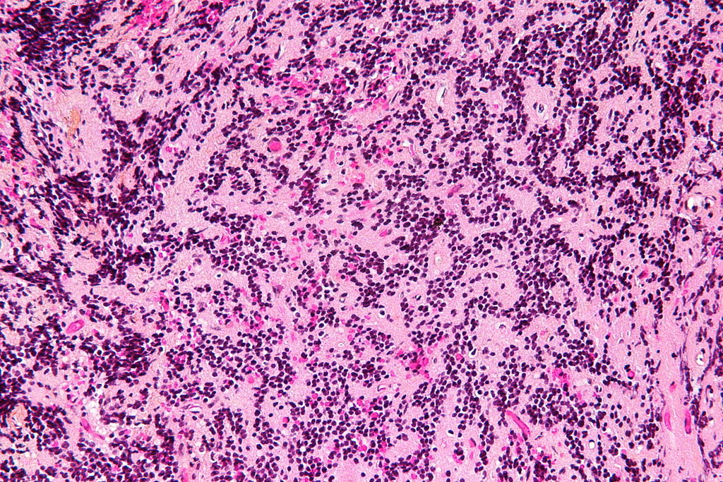 High magnification micrograph of a pineocytoma. HPS stain.[10]
