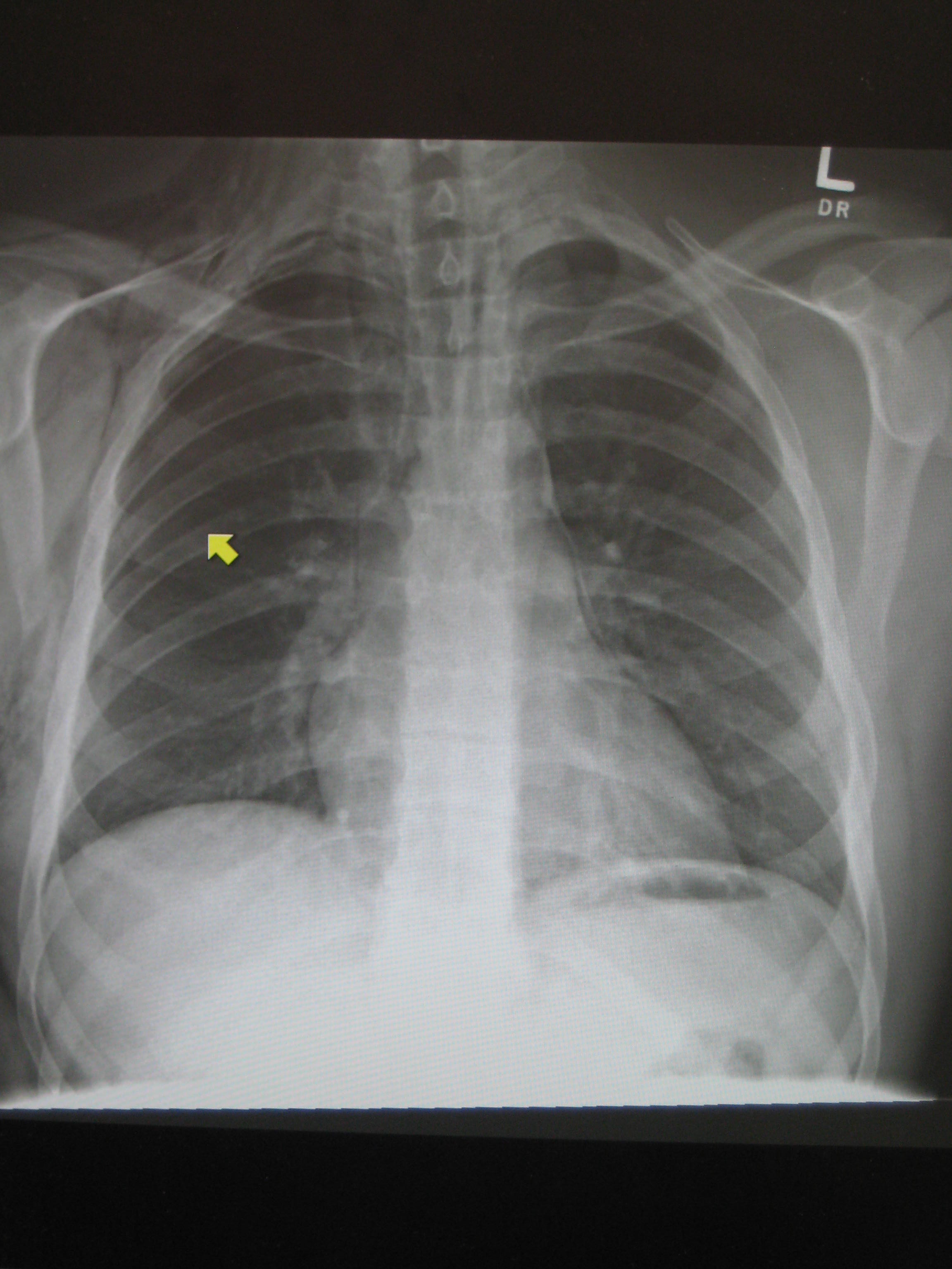 Pneumomediastinum chest x ray - wikidoc