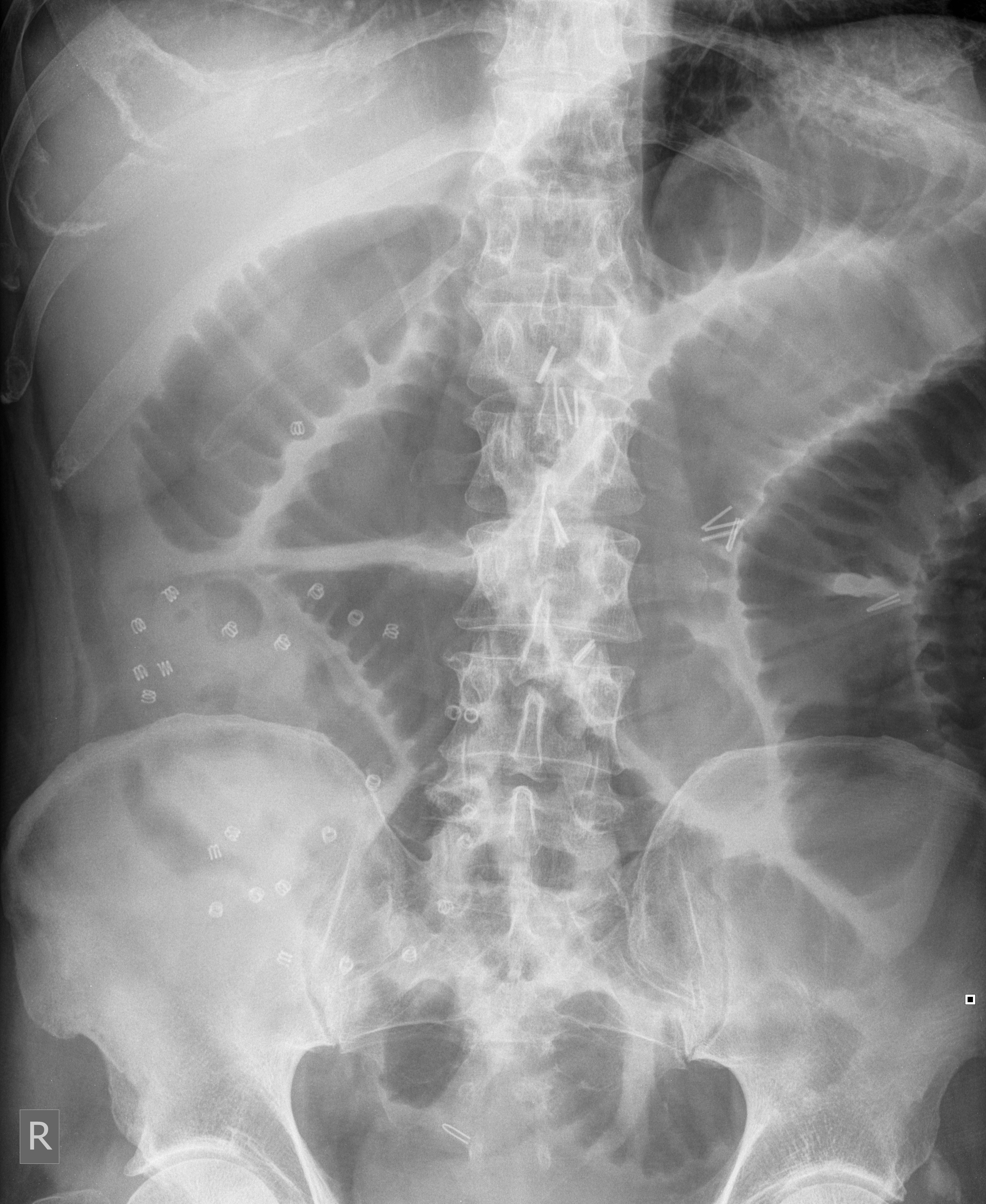 File:Small-bowel-obstruction-15.jpg