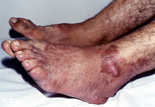 File:Tuberculoid leprosy08.jpg