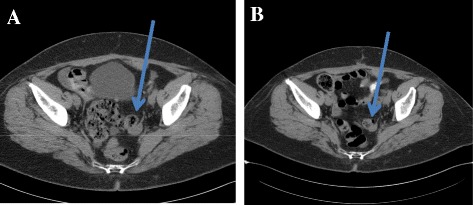 File:CT image of ovarian granulosa cell tumor.jpg