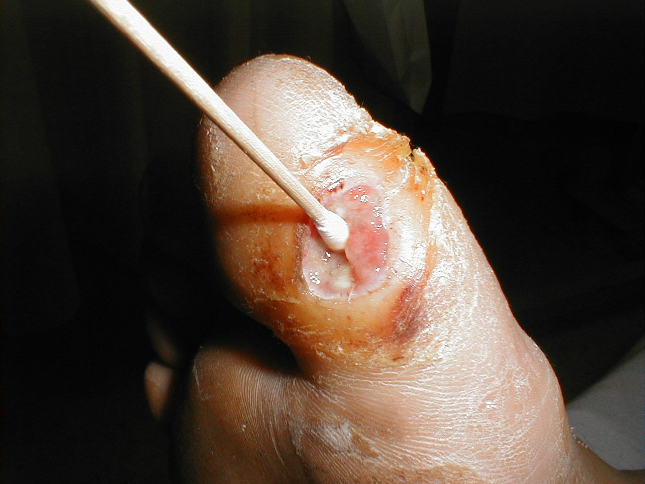 Clinical Osteomyelitis: Deep ulcer which permits passage of Q-tip to underlying level of bone
