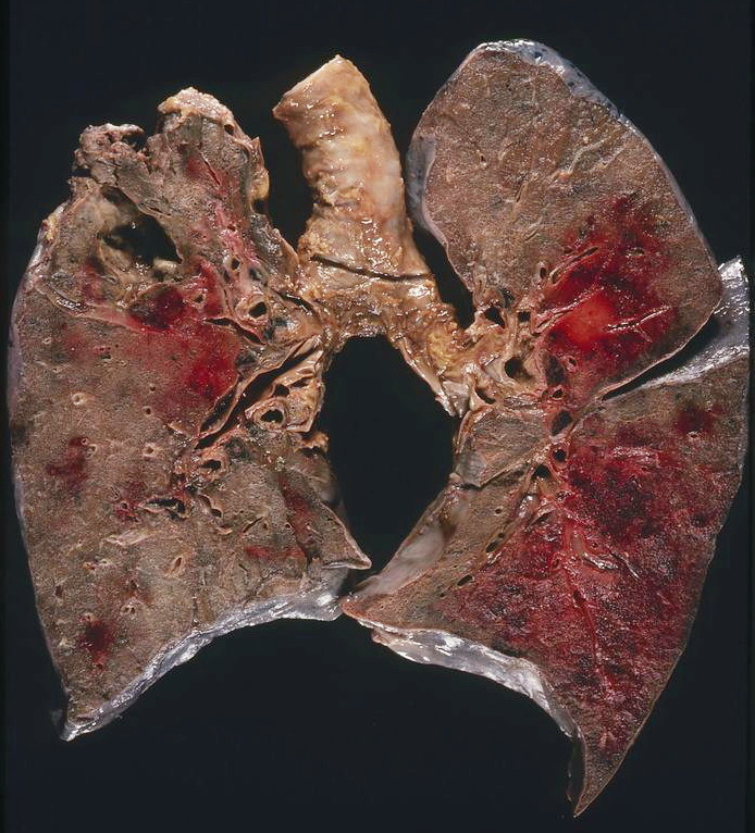 Pulmonary lesion of Kaposi sarcoma. Source: Wikimedia Commons [14]