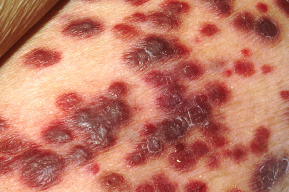 Kaposi sarcoma lesion Source: Wikimedia Commons.[17]