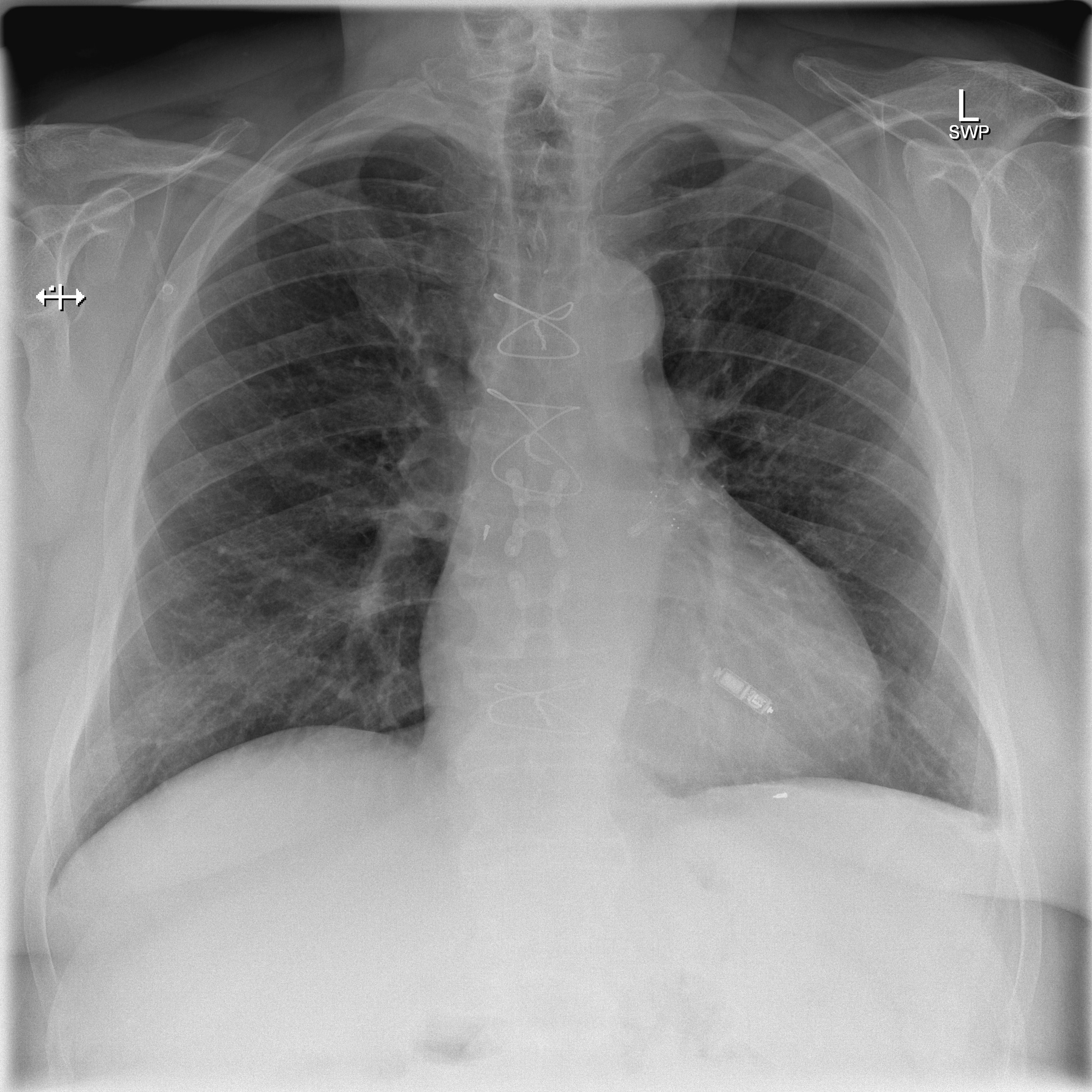 CXR showing a leadless pacemaker in the right ventricle, not to mistake the device with implantable loop recorder (ILR) - Case courtesy of Dr Marianne Cossens , Radiopaedia.org, rID: 61188