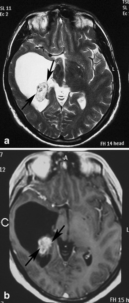 Classical appearance of a hemispheric pilocytic astrocytoma in a 45-year-old man. a An axial T2-weighted image demonstrates a hyperintense cystic component and a less hyperintense solid nodule within the lateral ventricle (arrows). b A contrast-enhanced axial T1-weighted image reveals intense enhancement of the solid nodule (arrows) and lack of enhancement of the cystic portion.[2]