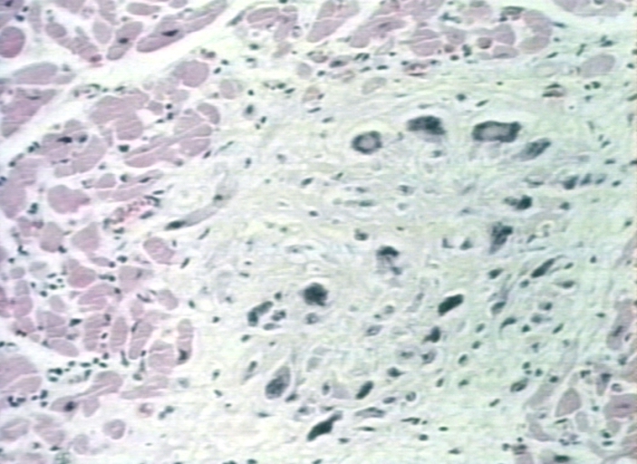 Aschoff bodies: microscopic histopathological analysis, Aschoff bodies in rheumatic heart disease.