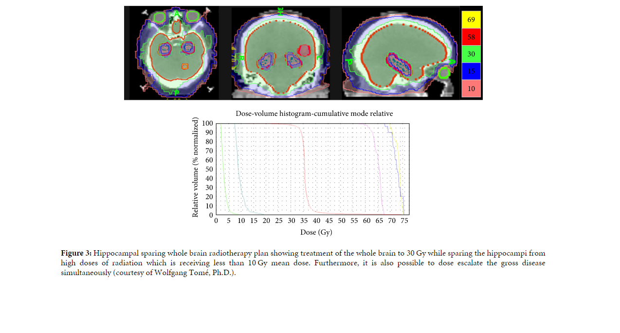 Hippocampal sparing whole brain radiotherapy plan showing treatment of the whole brain to 30 Gy while sparing the hippocampi from high doses of radiation which is receiving less than 10 Gy mean dose. Furthermore, it is also possible to dose escalate the gross disease simultaneously (courtesy of Wolfgang Tomé, Ph.D.).[2]