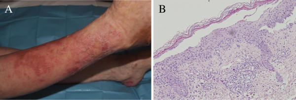 (A) Skin lesions affecting pretibial area. (B) Skin biopsy in necrolytic migratory erythema showing a zone of necrolysis and vacuolated keratinocytes[4]