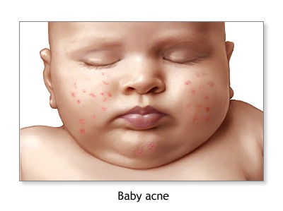 Baby acne is usually seen on the cheeks, chin, and forehead. It can be present at birth but usually develops around 3 to 4 weeks of age. Baby acne occurs when hormonal changes in the body stimulate oil glands in the baby's skin. The condition can look worse when the baby is crying or fussy, or any other instance that increases blood flow to the skin. Baby acne is harmless and usually resolves on its own within several weeks.