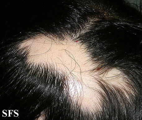 File:Alopecia areata 10.jpeg