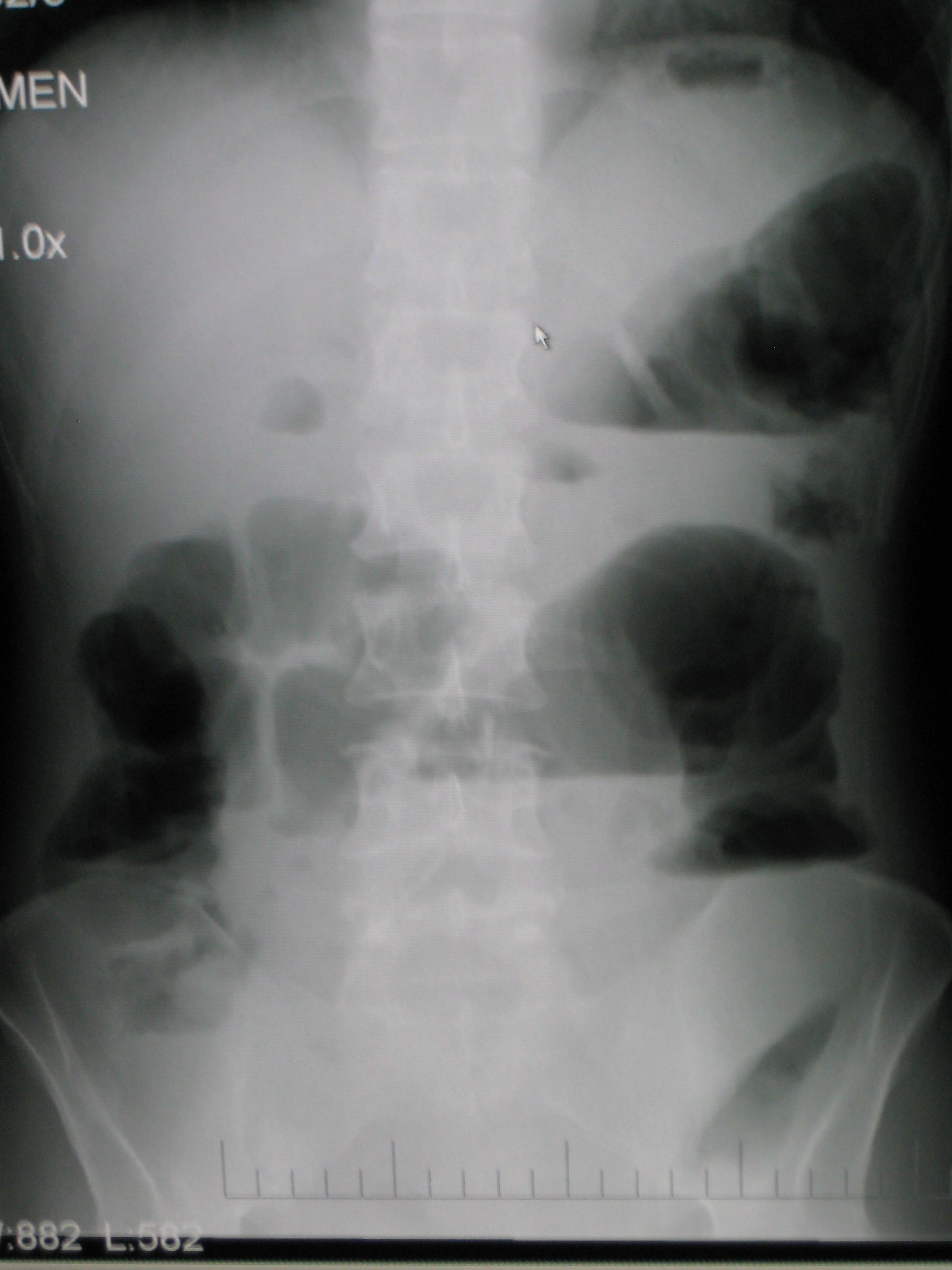 Upright abdominal X-ray demonstrating a small bowel obstruction. Note multiple air fluid levels.