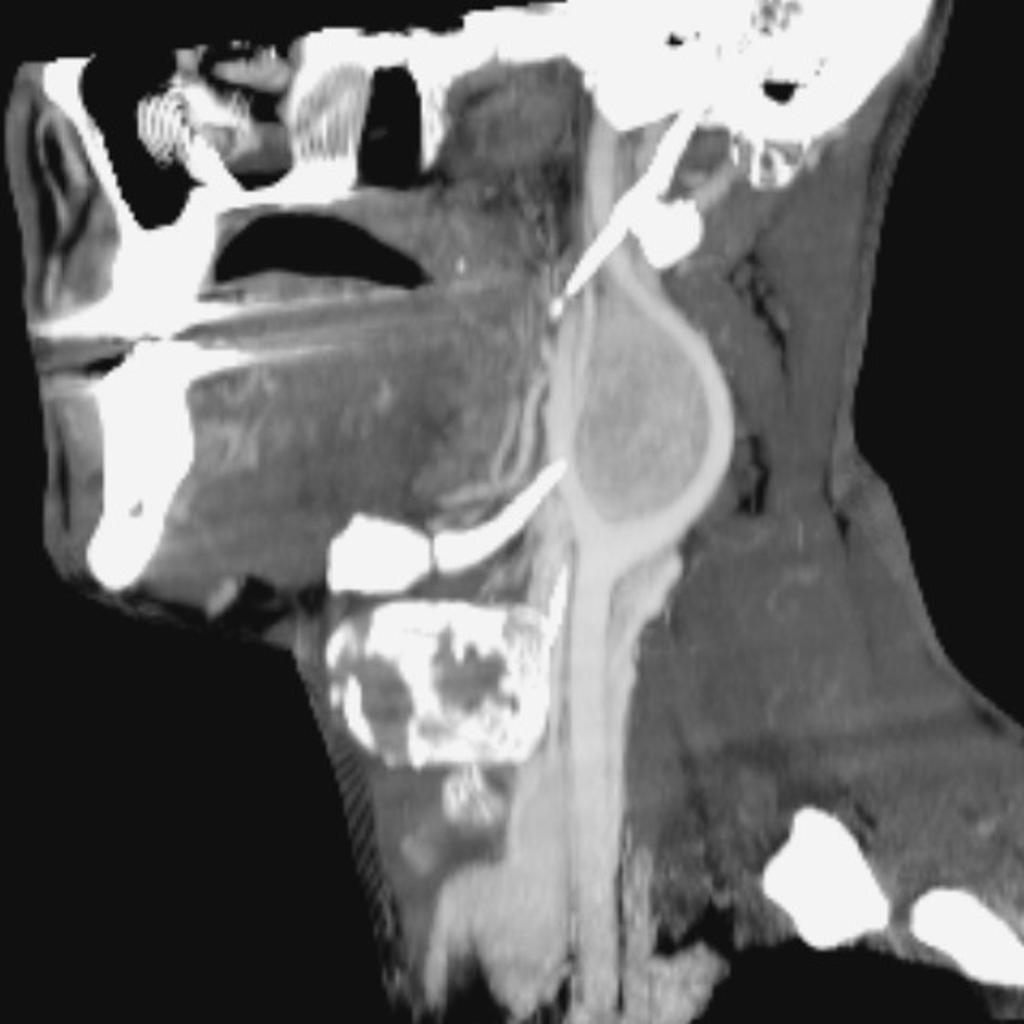 CT scan of carotid body tumor.[19]