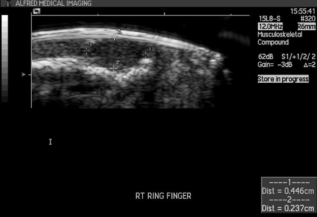 Ultrasound of right index finger; longitudinal view in a 35 year old female with bluish discolouration of the nail of the right ring finger and pain worsening with cold. A hypoechoic mass was seen beneath the area of nail discolouration and superficial to the area of cortical deficit.[2]
