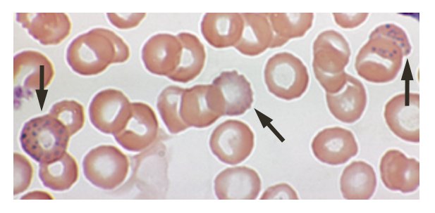 Basophilic stippling in a blood smear of a patient with lead poisoning