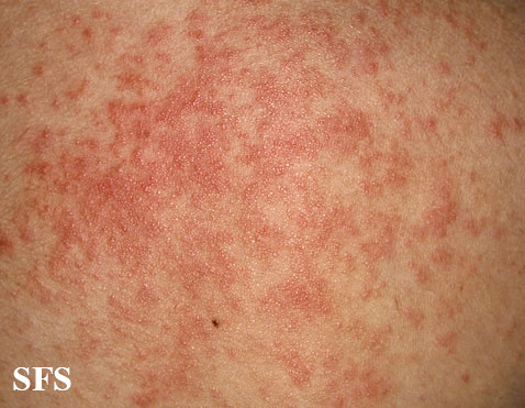 Heat Rash or Prickly Heat (Miliaria Rubra) Condition, Treatments and  Pictures for Teens - Skinsight